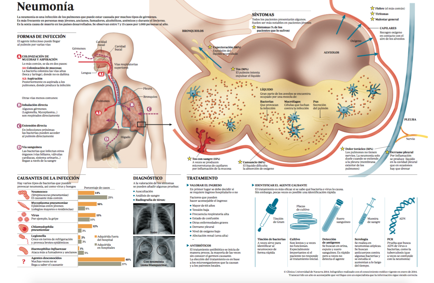 infografia  pneumonia CUN