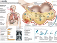 infografia pneumonia CUN